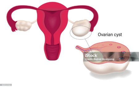 Polycystic Ovarian Disease (PCOD): Causes, Symptoms, and Natural Treatment Options in Ghana