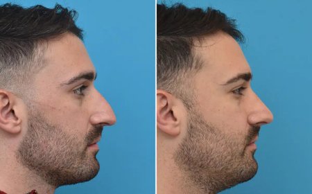 Everything You Should Know About Rhinoplasty