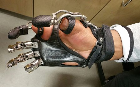 Understanding Prosthesis and Its Many Uses