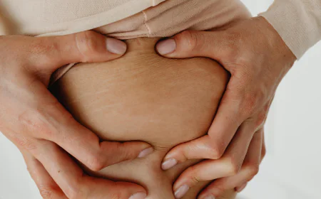 Best Stretch Marks Removal in Ghana – Natural Creams, Aloe Vera Gel & Skin Repair Essentials