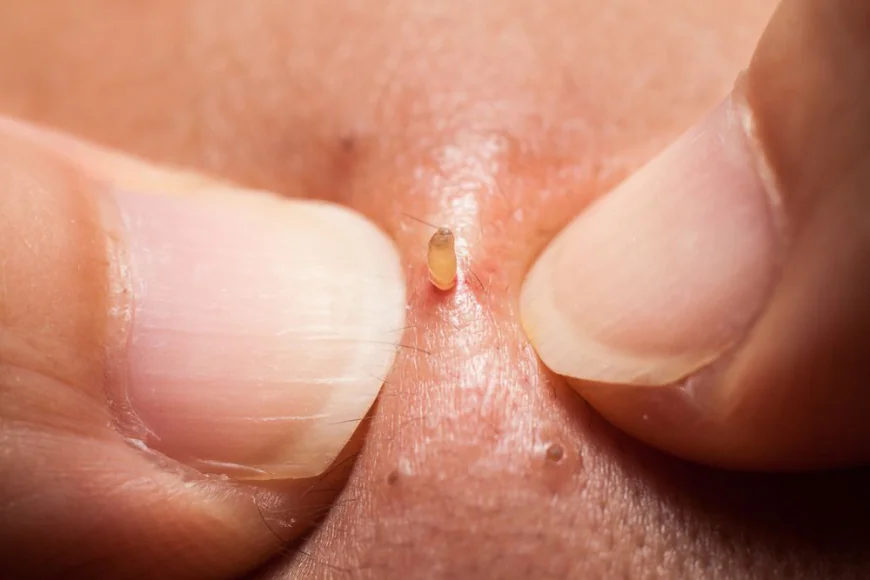 5 Reasons Why You Should Not Pop Your Pimples (And What to Do Instead)