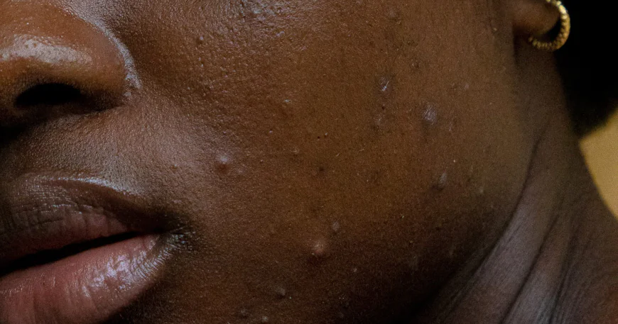 5 Reasons Why You Should Not Pop Your Pimples (And What to Do Instead)