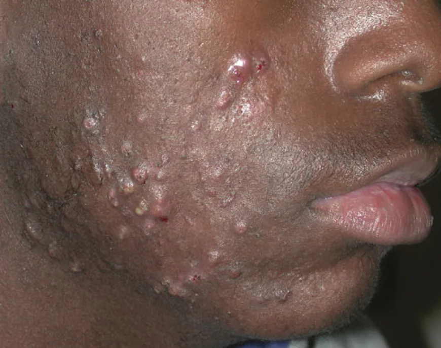 5 Reasons Why You Should Not Pop Your Pimples (And What to Do Instead)