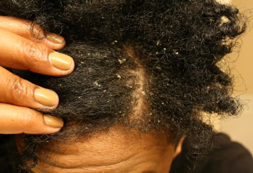 10 Simple Home Remedies to Curb Dandruff Naturally and Effectively